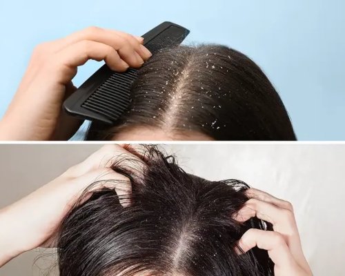 Dandruff & Scalp Care in Roorkee